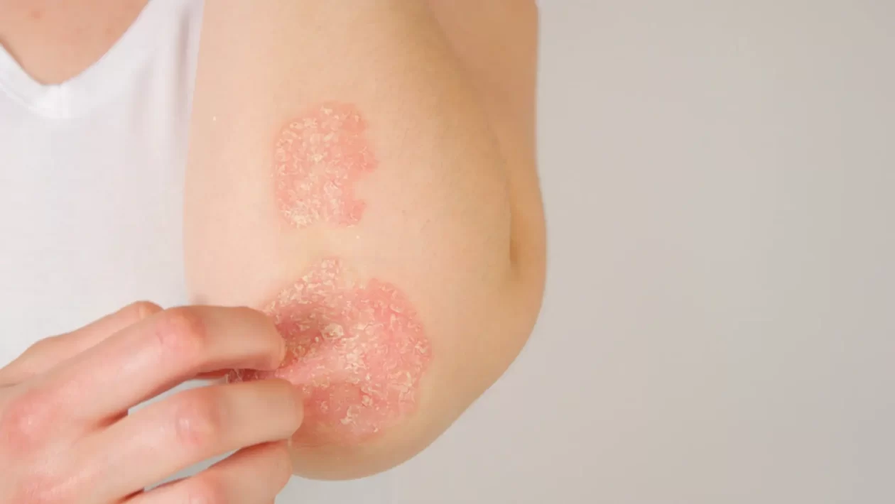 treating psoriasis the ayurvedic way