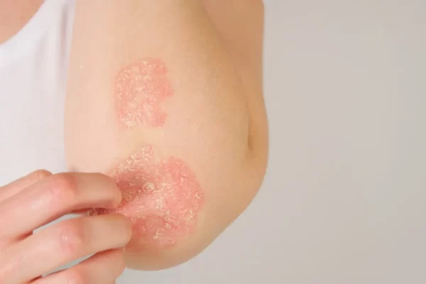 treating psoriasis the ayurvedic way