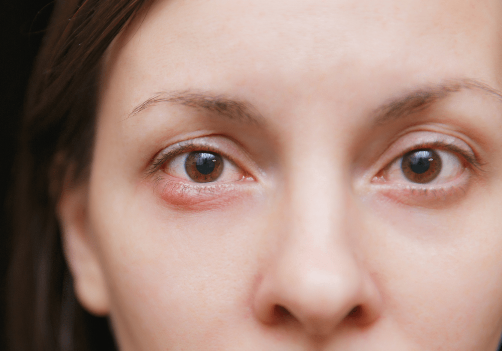 things-you-should-know-if-you-have-sunken-eyes-wellness365