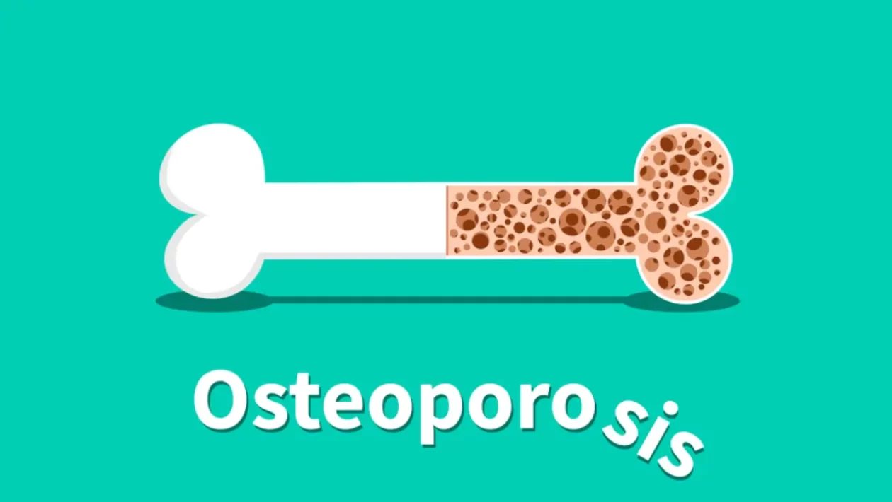 osteoporosis bone