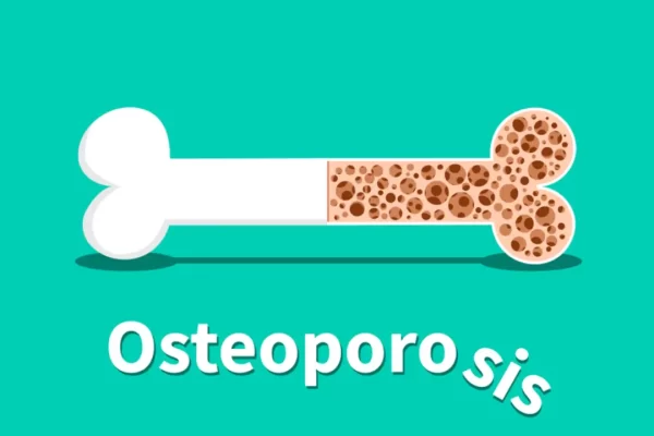 osteoporosis bone