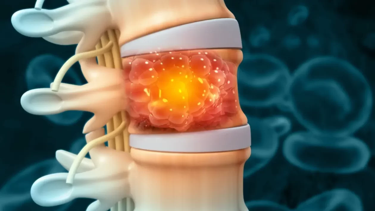 spinal tumor